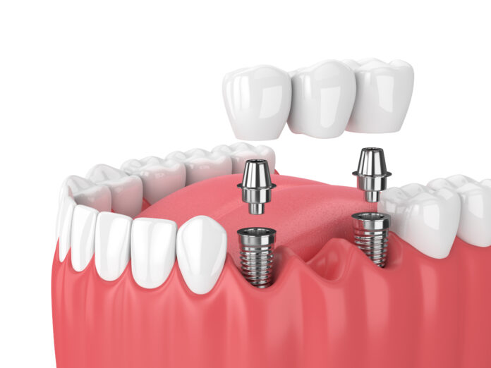 Implants Dental